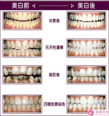 矫正牙齿法令纹