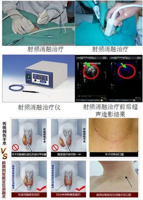 怎么治疗淋巴结节