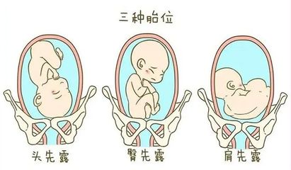 胎儿一直臀位说明宝宝有问题