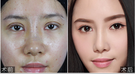 深圳美莱双眼皮怎么样