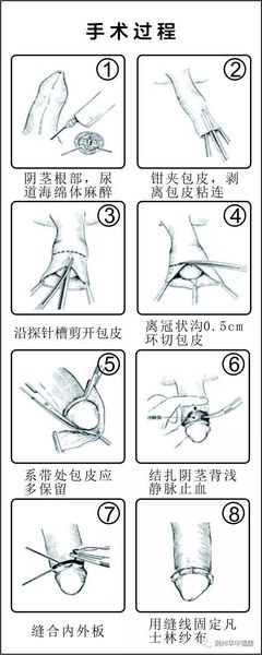 手动包皮粘连分离清洗多少钱