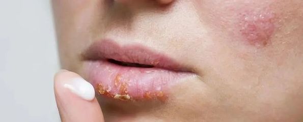 新生儿脓包疮