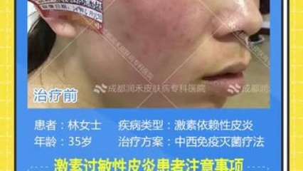 成都皮炎所治痘痘
