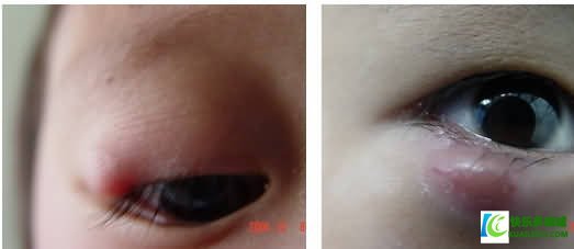长针眼怎么治疗