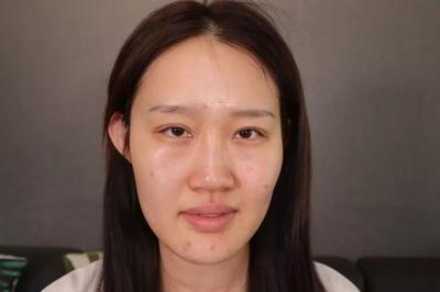 白色的大痘痘是什么原因