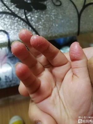头皮炎怎么治疗