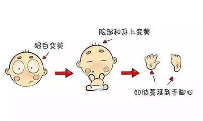 母乳停多少小时黄疸能好