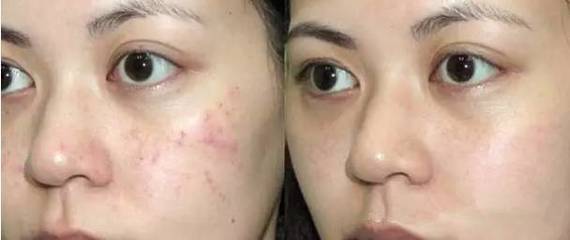脸上有痘痘能打水光针吗