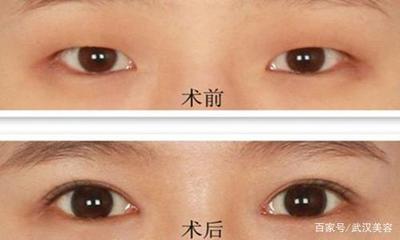 韩式做双眼皮多少钱