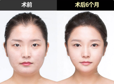 脸型不正左右脸不对称