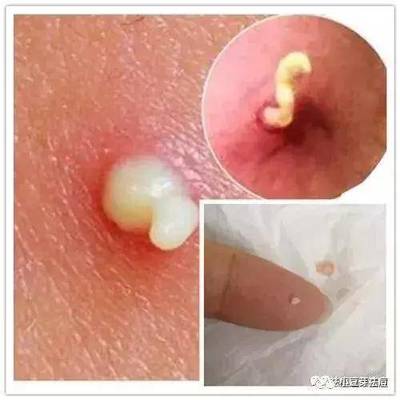 挤出白头的痘痘