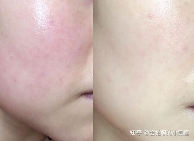 痘痘肌用哪种水乳比较好