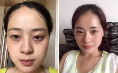 脸上突然长斑是怎么回事