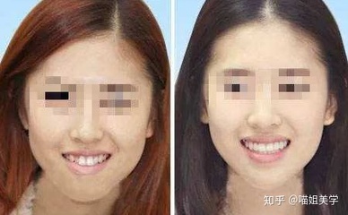 脸型不正左右脸不对称