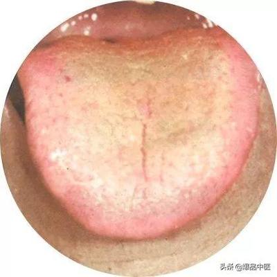 舌苔灰色是怎么回事