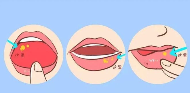 怀孕了口腔溃疡怎么办