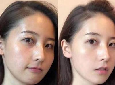 痘痘肌用什么脸部精华液