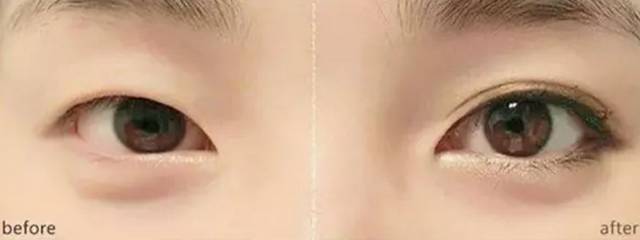 能贴双眼皮贴睡觉吗