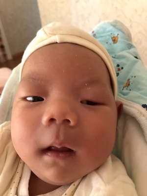 宝宝上眼睑下垂怎么办