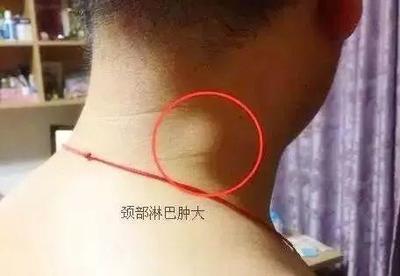 一岁宝宝耳后淋巴结肿大怎么办