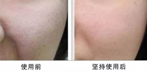 敏感肌肤痘痘发红
