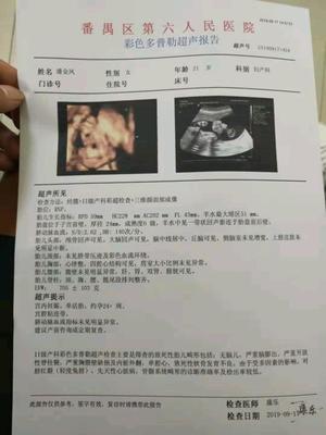 宫腔粘连怀孕怎么办