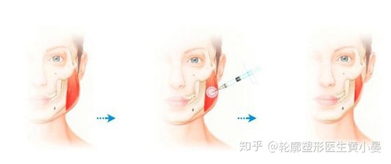 黄金微雕瘦脸