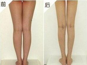 抽脂痛不痛
