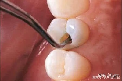补牙后牙疼吃什么药
