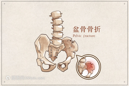 盆骨骨折怎么治疗