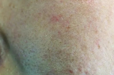 用什么泡水排痘痘