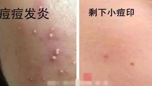 怎么根治痘痘的方法