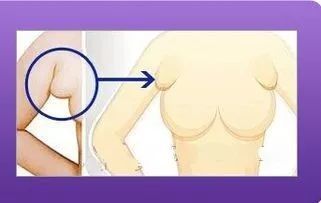 怀孕长副乳怎么办