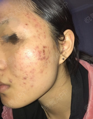 脸上有痘痘能打水光针吗