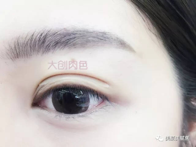 单眼皮肿眼泡怎么贴双眼皮