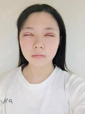割双眼皮消炎针打几天