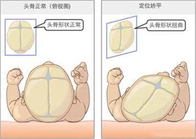 新生儿前卤门大小标准