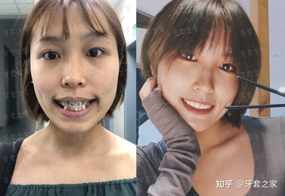 矫正牙齿前后