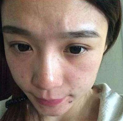 脸颊长斑是怎么回事