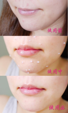 痘痘肌用后的哪个系列
