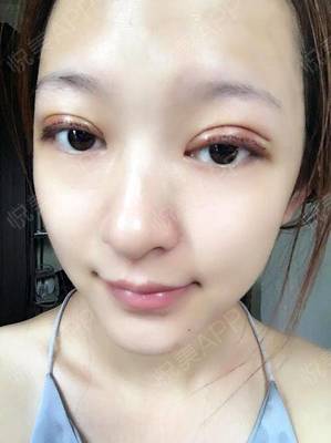 开眼角拆线后多久化妆