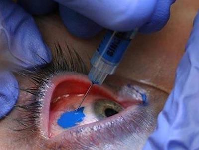 眼球结膜手术多少钱
