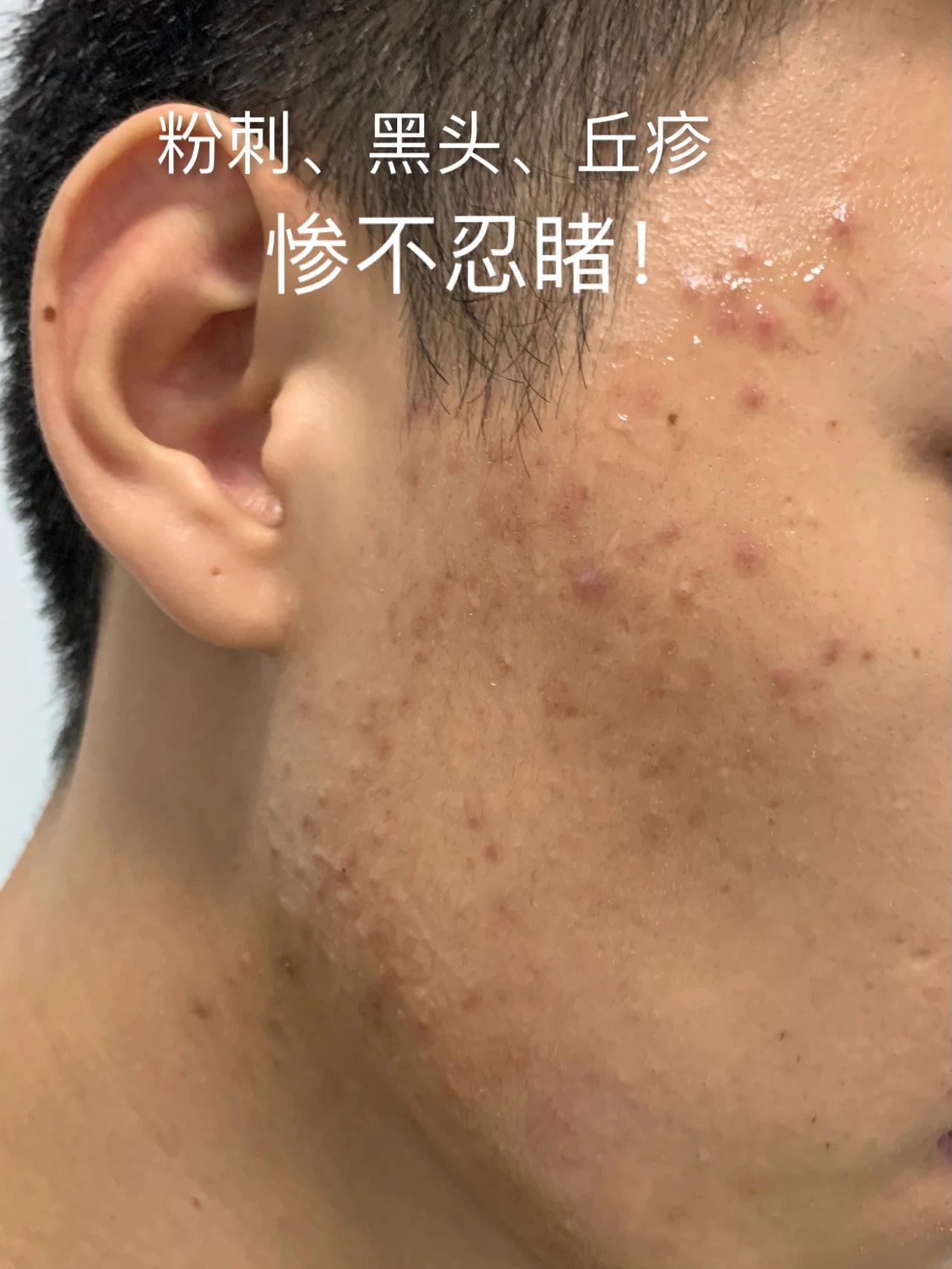 脸上红肿痘痘痘印
