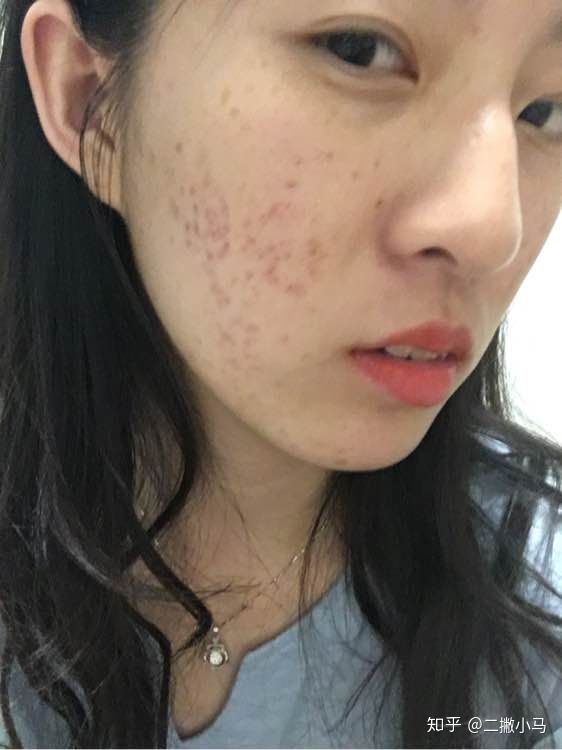 脓包型痤疮怎么治疗