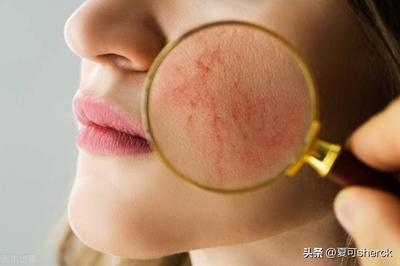 痘痘肌到底用不用面霜