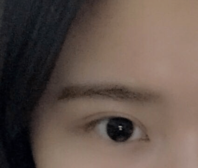 右眼皮肿是怎么回事