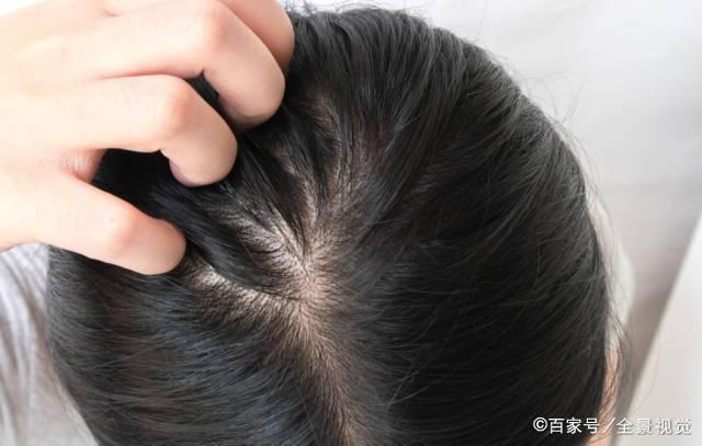 头皮长痘痘有点脱发