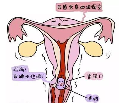 怀孕药流过程