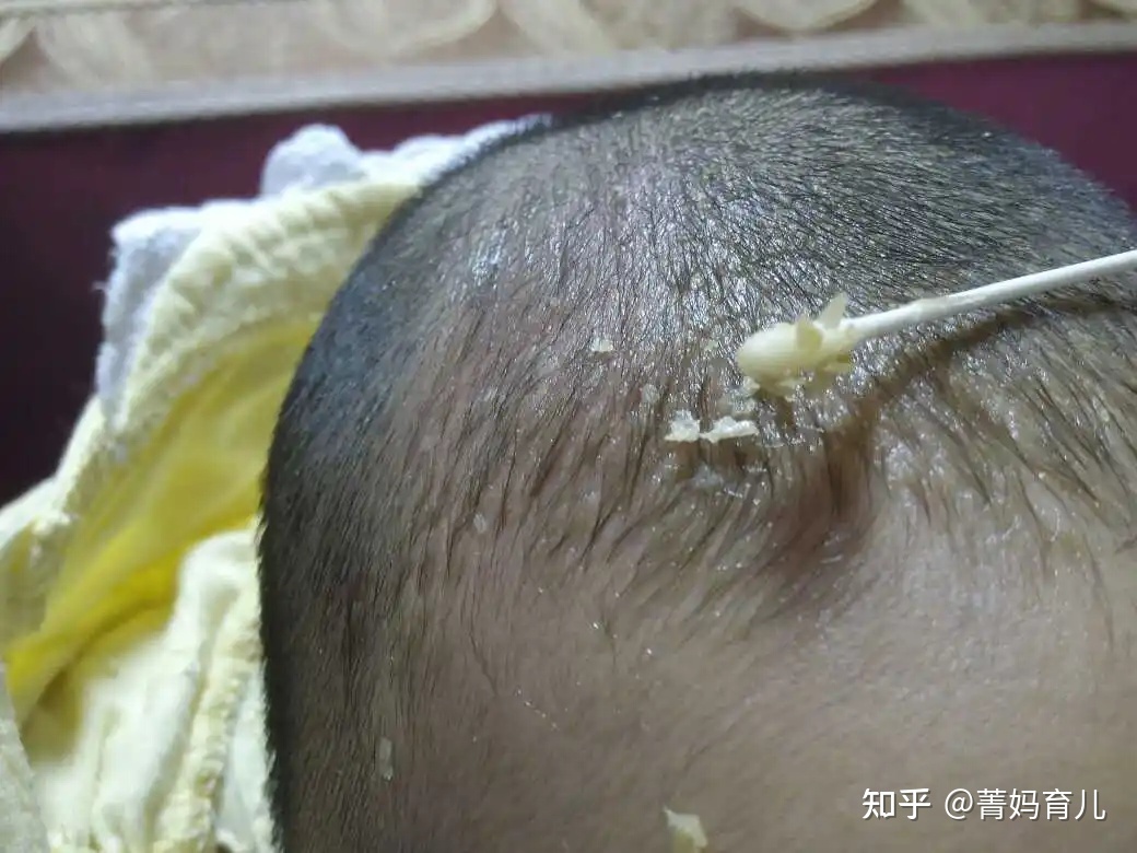 新生儿乳痂图片