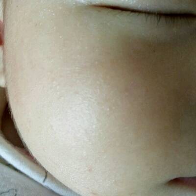 脸上为什么会起痘痘